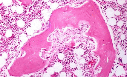 Image: Light micrograph of a section through a rheumatoid nodule, a manifestation of rheumatoid arthritis outside of a joint (photo courtesy Biophoto Associates / SPL).